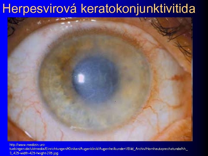 Herpesvirová keratokonjunktivitida http: //www. medizin. unituebingen. de/uktmedia/Einrichtungen/Kliniken/Augenklinik/Augenheilkunde+I/Bild_Archiv/Hornhautsprechstunde/hh_ 3_425 -width-425 -height-285. jpg 