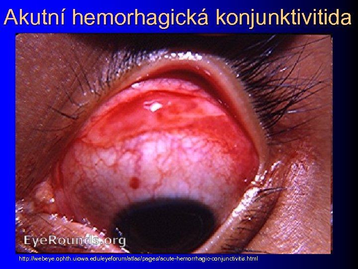 Akutní hemorhagická konjunktivitida http: //webeye. ophth. uiowa. edu/eyeforum/atlas/pages/acute-hemorrhagic-conjunctivitis. html 
