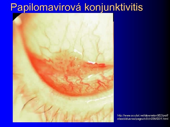 Papilomavirová konjunktivitis http: //www. oculist. net/downaton 502/prof/ ebook/duanes/pages/v 8/ch 095/001 f. html 