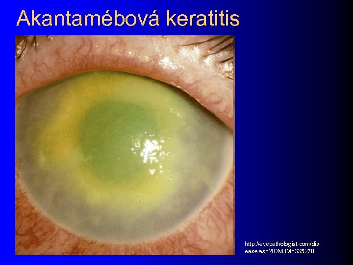 Akantamébová keratitis http: //eyepathologist. com/dis ease. asp? IDNUM=335270 