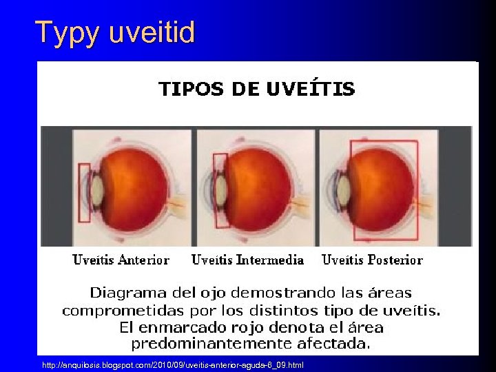 Typy uveitid http: //anquilosis. blogspot. com/2010/09/uveitis-anterior-aguda-6_09. html 