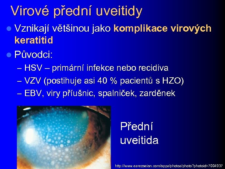 Virové přední uveitidy l Vznikají většinou jako komplikace virových keratitid l Původci: – HSV
