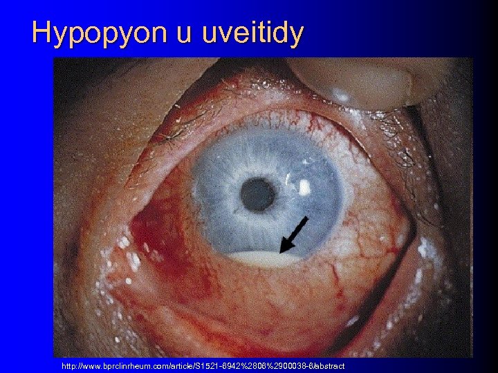 Hypopyon u uveitidy http: //www. bprclinrheum. com/article/S 1521 -6942%2806%2900038 -6/abstract 