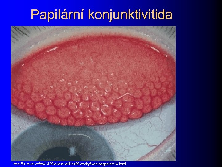 Papilární konjunktivitida http: //is. muni. cz/do/1499/el/estud/lf/ps 09/cocky/web/pages/str 14. html 