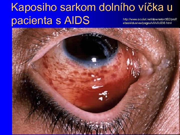 Kaposiho sarkom dolního víčka u pacienta s AIDS http: //www. oculist. net/downaton 502/prof/ ebook/duanes/pages/v