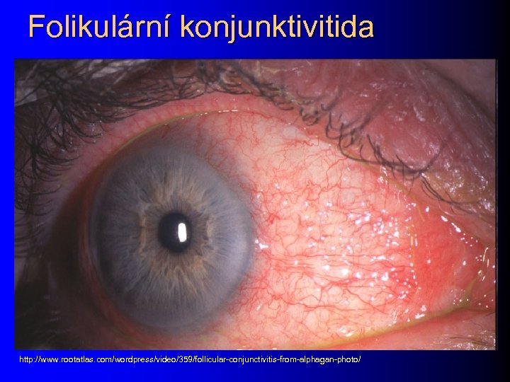 Folikulární konjunktivitida http: //www. rootatlas. com/wordpress/video/359/follicular-conjunctivitis-from-alphagan-photo/ 