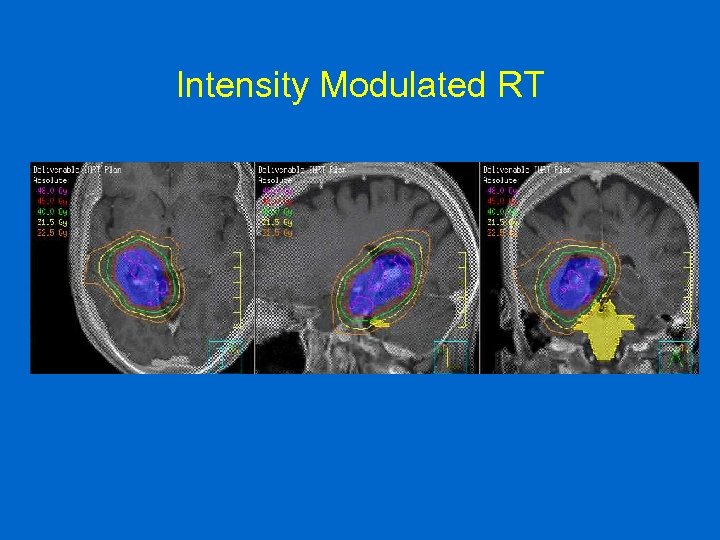 Intensity Modulated RT 