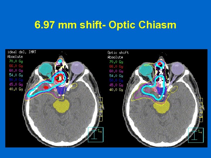 6. 97 mm shift- Optic Chiasm 