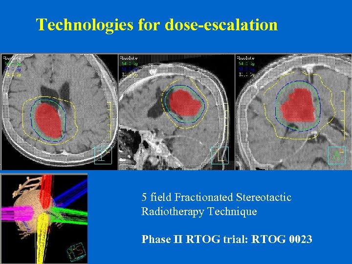 Technologies for dose-escalation 5 field Fractionated Stereotactic Radiotherapy Technique Phase II RTOG trial: RTOG