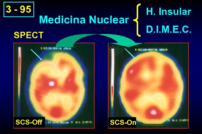 3 - 95 Medicina Nuclear SPECT SCS-Off SCS-On H. Insular D. I. M. E.
