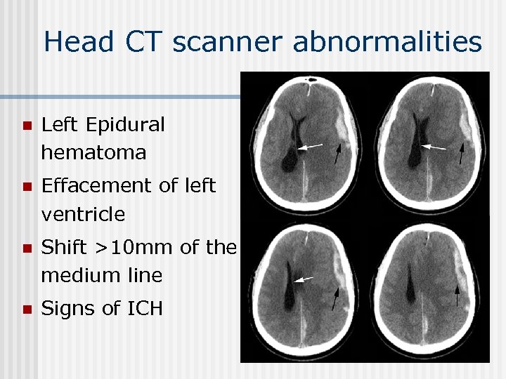 Head CT scanner abnormalities n Left Epidural hematoma n Effacement of left ventricle n