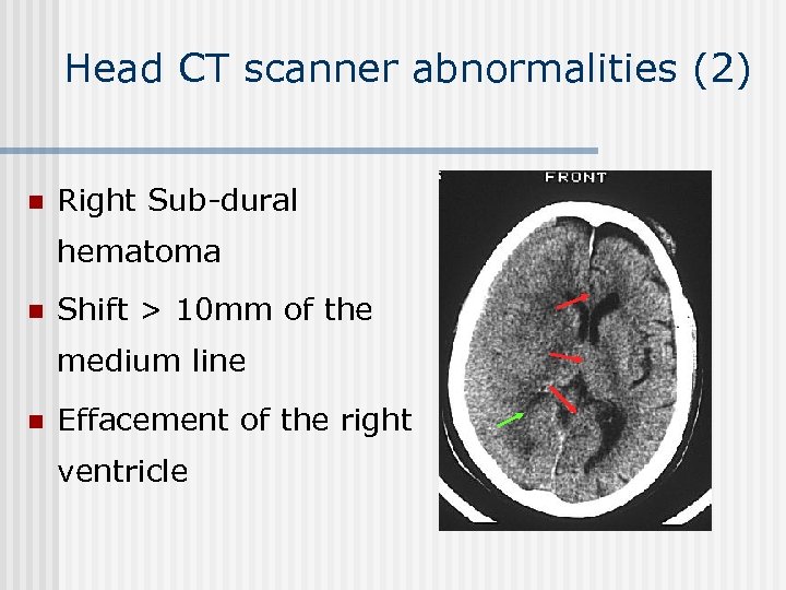 Head CT scanner abnormalities (2) n Right Sub-dural hematoma n Shift > 10 mm
