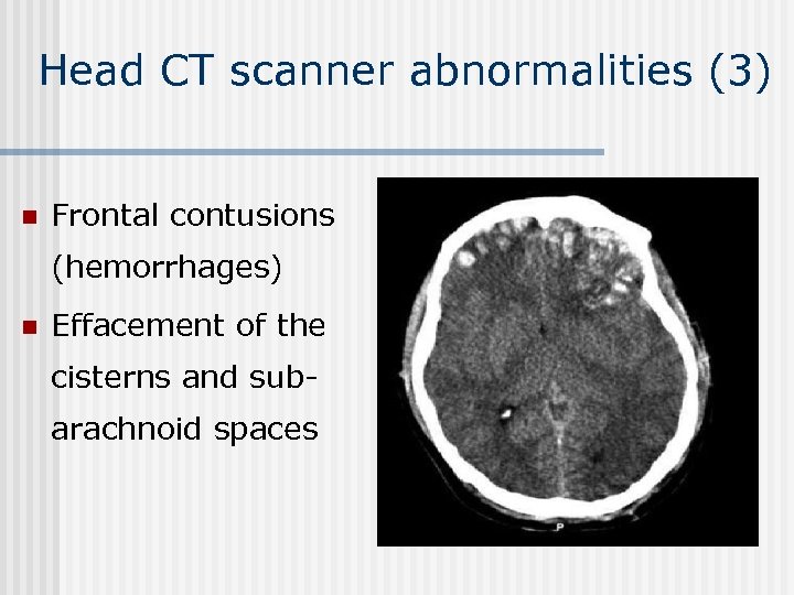 Head CT scanner abnormalities (3) n Frontal contusions (hemorrhages) n Effacement of the cisterns
