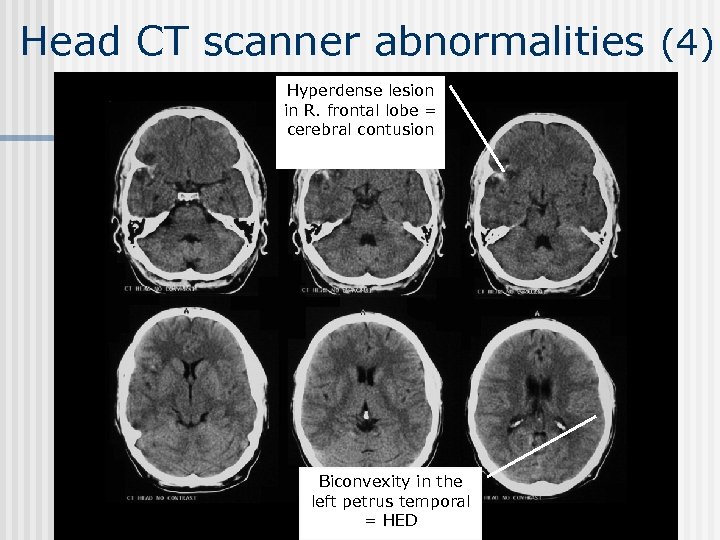 Head CT scanner abnormalities (4) Hyperdense lesion in R. frontal lobe = cerebral contusion