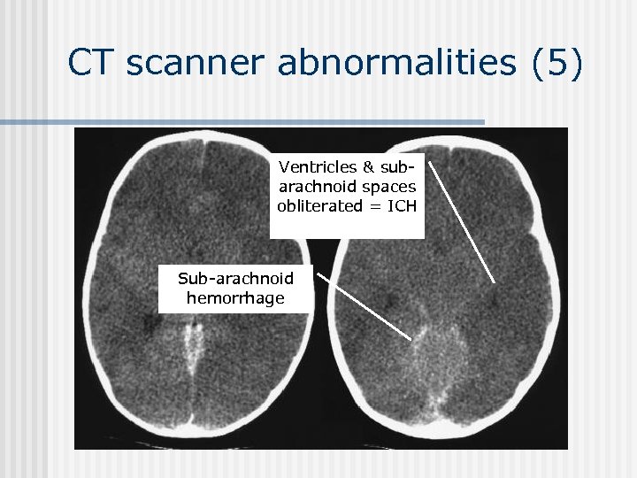 CT scanner abnormalities (5) Ventricles & subarachnoid spaces obliterated = ICH Sub-arachnoid hemorrhage 