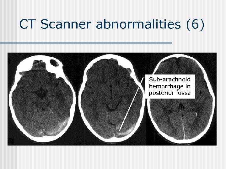 CT Scanner abnormalities (6) Sub-arachnoid hemorrhage in posterior fossa 