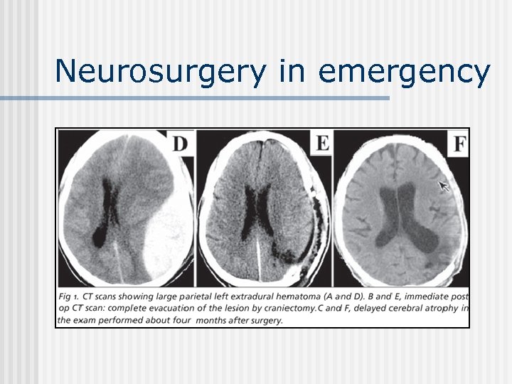 Neurosurgery in emergency 