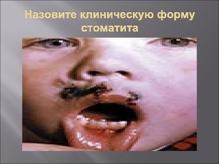 Назовите клиническую форму стоматита 