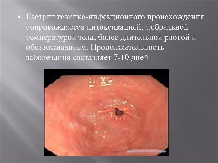  Гастрит токсико-инфекционного происхождения сопровождается интоксикацией, фебральной температурой тела, более длительной рвотой и обезвоживанием.