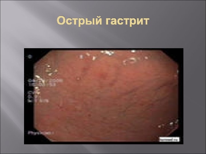 Острый гастрит 