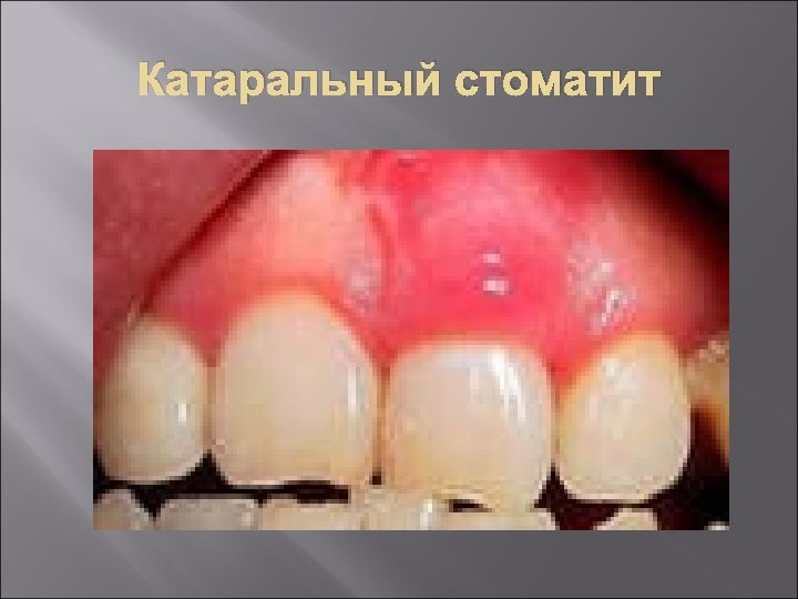 Катаральный стоматит 