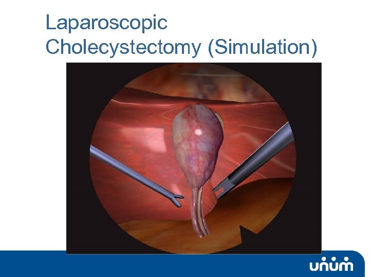 Laparoscopic Cholecystectomy (Simulation) 