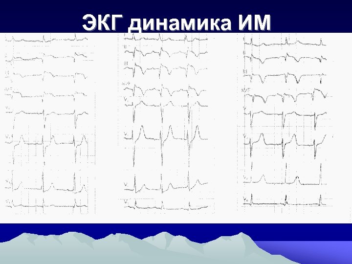 ЭКГ динамика ИМ 