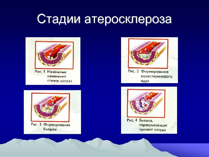 Стадии атеросклероза 