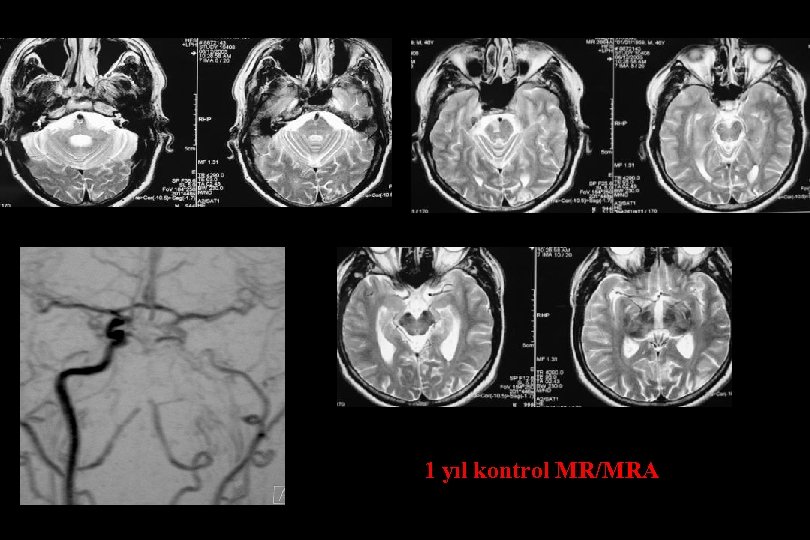 11 yıl kontrol MR/MRA 