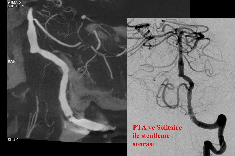 PTA ve Solitaire ile stentleme sonrası 