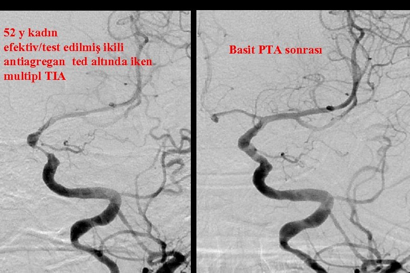 52 y kadın efektiv/test edilmiş ikili antiagregan ted altında iken multipl TIA Basit PTA