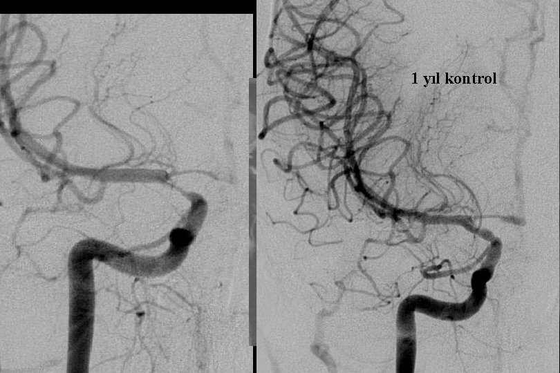 1 yıl kontrol PTA Sonrası 