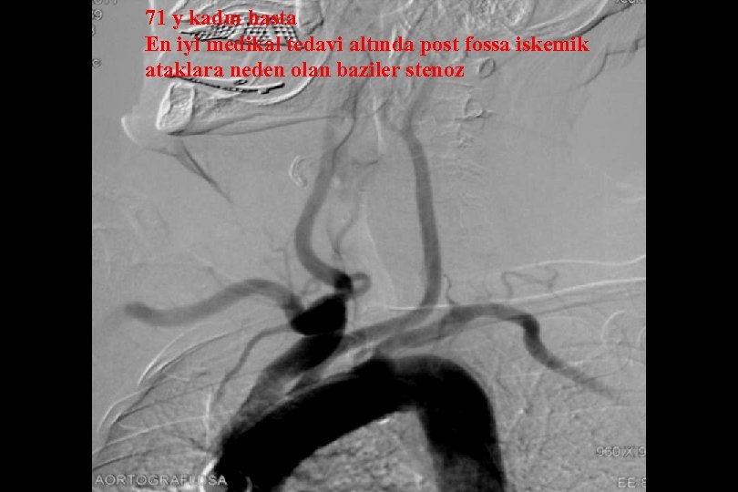71 y kadın hasta En iyi medikal tedavi altında post fossa iskemik ataklara neden