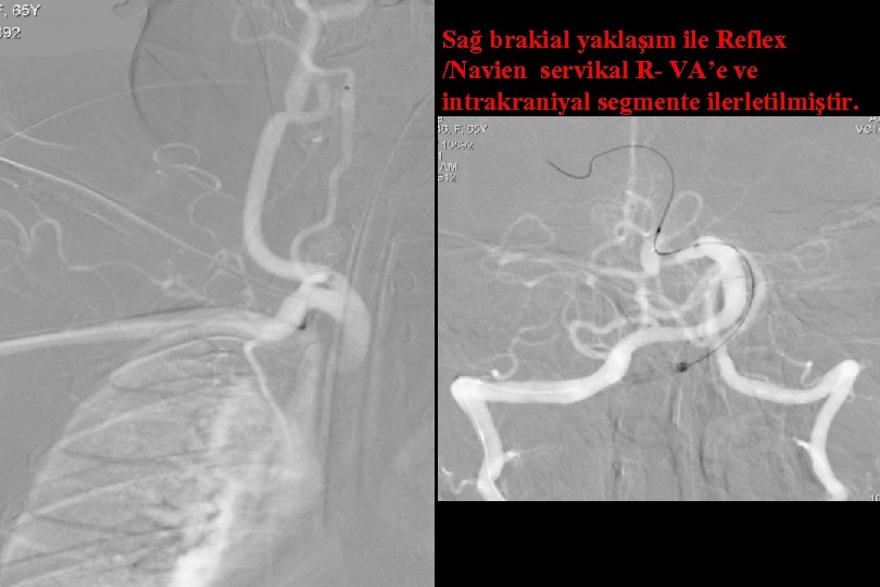 Sağ brakial yaklaşım ile Reflex /Navien servikal R- VA’e ve intrakraniyal segmente ilerletilmiştir. 