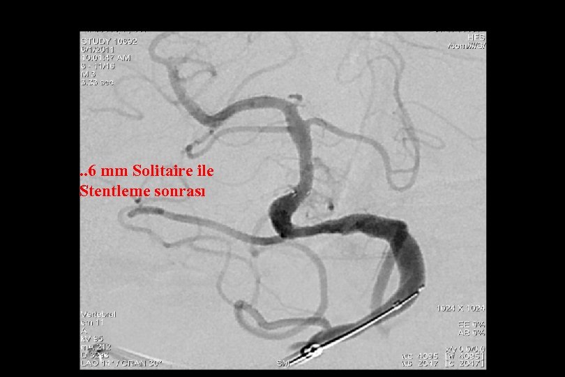 . . 6 mm Solitaire ile Stentleme sonrası 