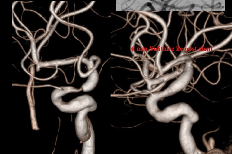 66 mm Solitaire ile post stent 