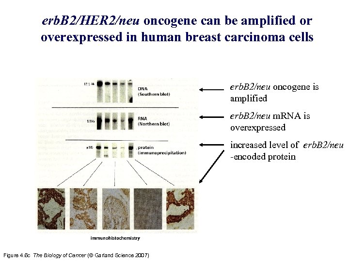 erb. B 2/HER 2/neu oncogene can be amplified or overexpressed in human breast carcinoma