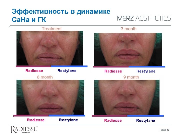 Эффективность в динамике Са. На и ГК Radiesse Restylane | page 12 