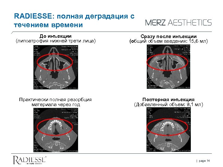 RADIESSE: полная деградация с течением времени До инъекции (липоатрофия нижней трети лица) Сразу после