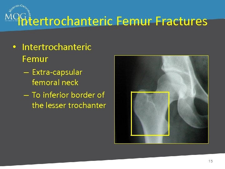 Intertrochanteric Femur Fractures • Intertrochanteric Femur – Extra-capsular femoral neck – To inferior border