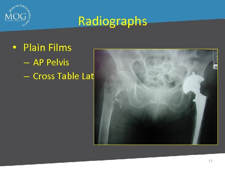 Radiographs • Plain Films – AP Pelvis – Cross Table Lateral 17 