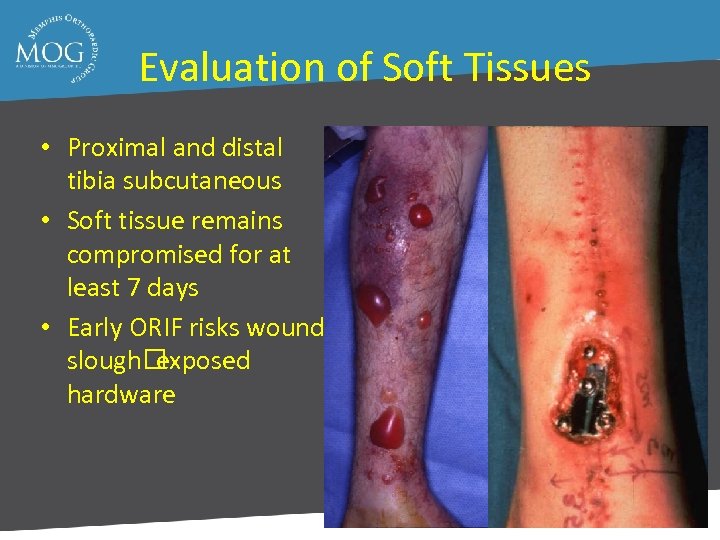 Evaluation of Soft Tissues • Proximal and distal tibia subcutaneous • Soft tissue remains