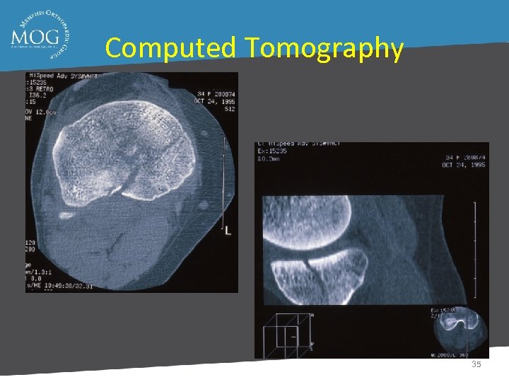 Computed Tomography 35 