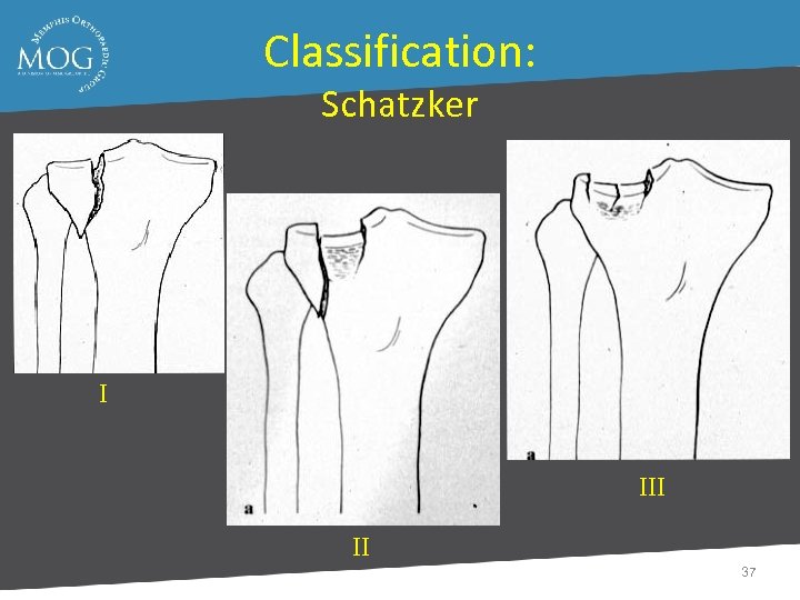 Classification: Schatzker I II 37 