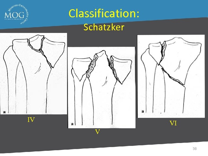 Classification: Schatzker IV VI V 38 