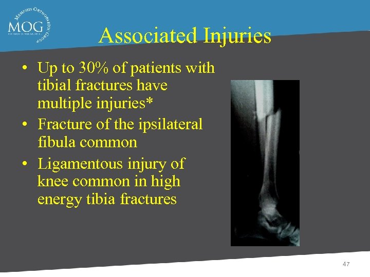 Associated Injuries • Up to 30% of patients with tibial fractures have multiple injuries*