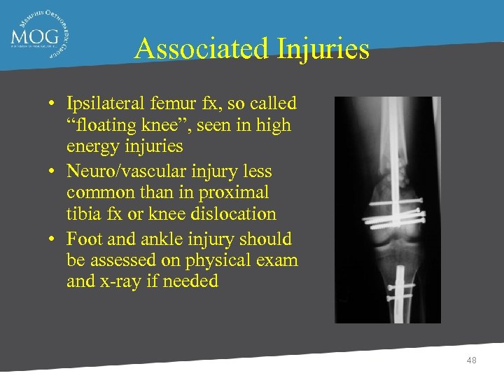 Associated Injuries • Ipsilateral femur fx, so called “floating knee”, seen in high energy