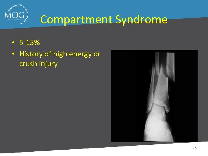 Compartment Syndrome • 5 -15% • History of high energy or crush injury 49