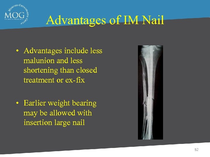 Advantages of IM Nail • Advantages include less malunion and less shortening than closed