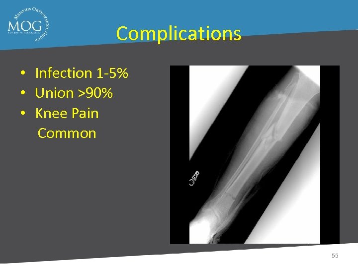 Complications • Infection 1 -5% • Union >90% • Knee Pain Common 55 